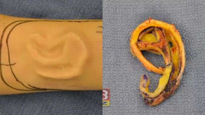 Лікарі виростили вушну раковину на руці жінки (5 фото)