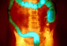 Токсичні бактерії та виразковий коліт: нове розуміння запальних захворювань кишечника